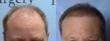 Dr. Michael Vories Performs Largest FUE Scalp Hair Transplant